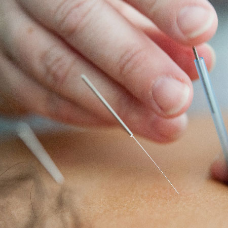 La pratique de l'acupuncture consiste à inserer de petites aiguilles sur des méridiens